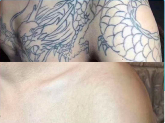 How to Train Your Tattoo Shop Staff to Perform Laser Tattoo Removal (The Practical Guide)